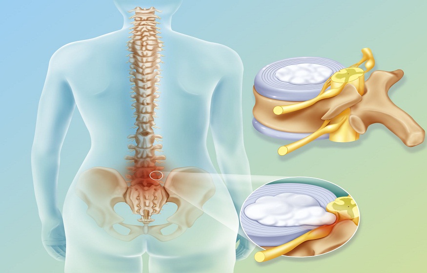 Discs for Spinal Surgery